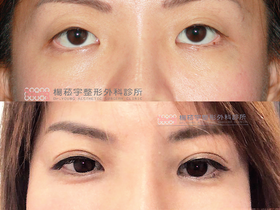 【讓妳的美,猶如天生】割雙眼皮&開眼頭
