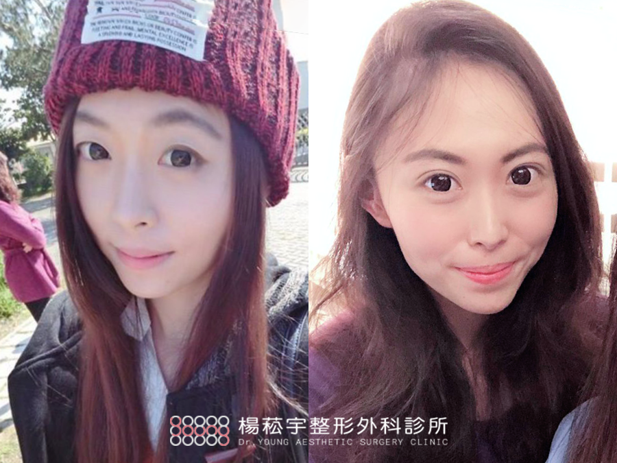 【自然系雙眼皮誕生記】天生雙眼皮≠天生好看的雙眼皮