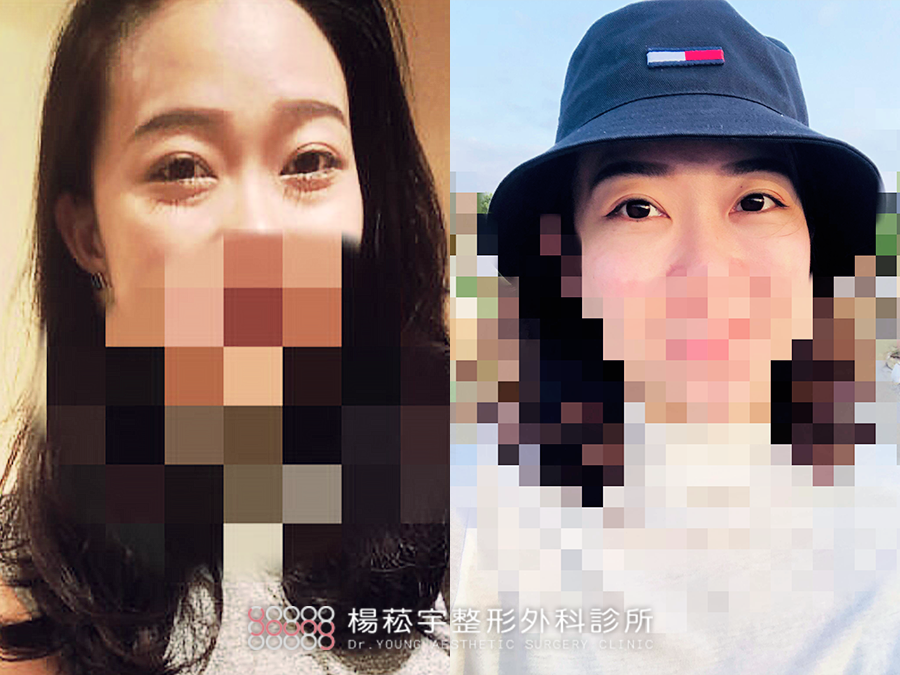 【小姊姊青春大逆襲】眼袋內開&淚溝補脂